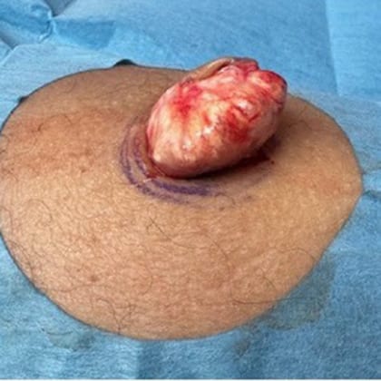 exerese pilomatricome mollet droit dr arnaud petit chirurgien dermatologique paris 3