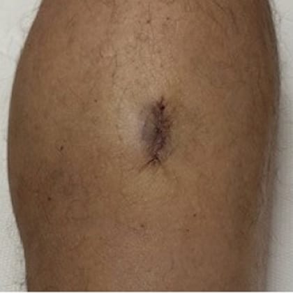 exerese pilomatricome mollet droit dr arnaud petit chirurgien dermatologique paris 5