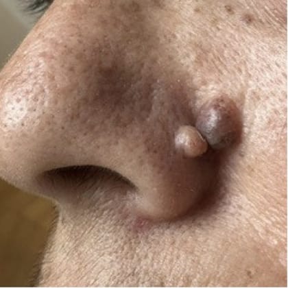 exerese simultanee deux grains beaute visage dr arnaud petit chirurgien esthetique paris 1