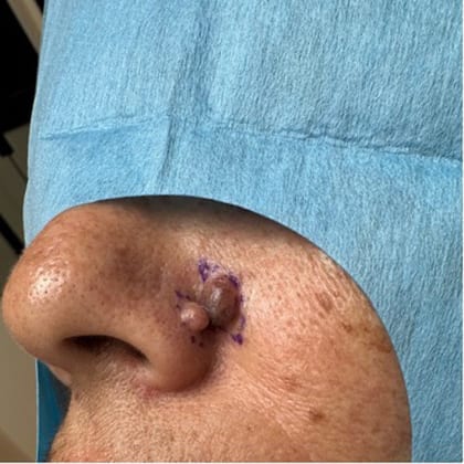 exerese simultanee deux grains beaute visage dr arnaud petit chirurgien esthetique paris 2