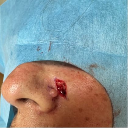 exerese simultanee deux grains beaute visage dr arnaud petit chirurgien esthetique paris 3