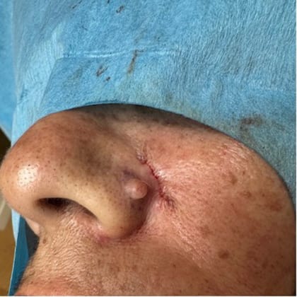 exerese simultanee deux grains beaute visage dr arnaud petit chirurgien esthetique paris 4