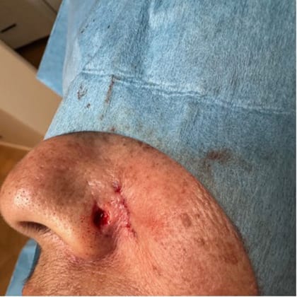 exerese simultanee deux grains beaute visage dr arnaud petit chirurgien esthetique paris 5