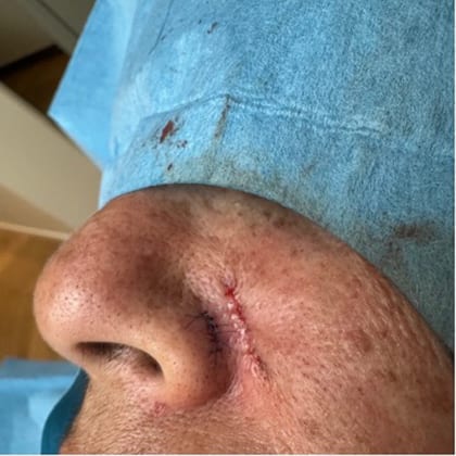 exerese simultanee deux grains beaute visage dr arnaud petit chirurgien esthetique paris 6