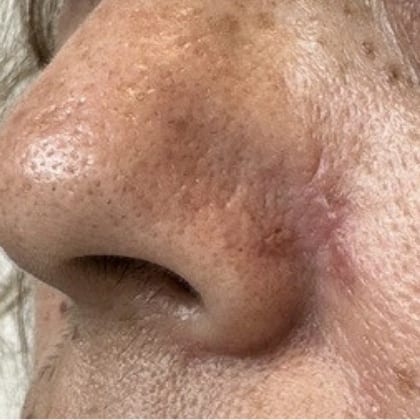 exerese simultanee deux grains beaute visage dr arnaud petit chirurgien esthetique paris 7
