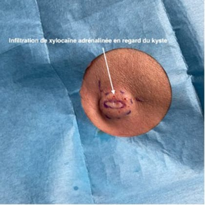 kyste epidermique angle mandibulaire droit dr arnaud petit chirurgien esthetique paris 1