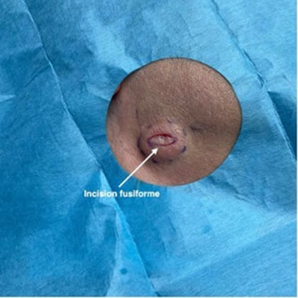 kyste epidermique angle mandibulaire droit dr arnaud petit chirurgien esthetique paris 2