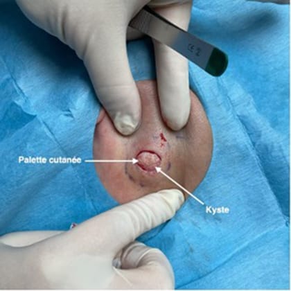 kyste epidermique angle mandibulaire droit dr arnaud petit chirurgien esthetique paris 3