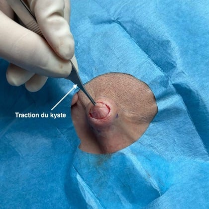 kyste epidermique angle mandibulaire droit dr arnaud petit chirurgien esthetique paris 4