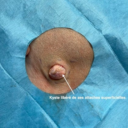 kyste epidermique angle mandibulaire droit dr arnaud petit chirurgien esthetique paris 5