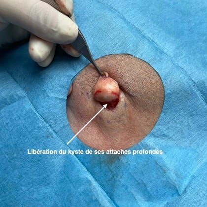 kyste epidermique angle mandibulaire droit dr arnaud petit chirurgien esthetique paris 6