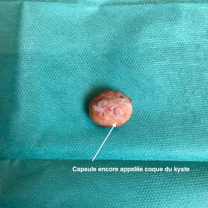 kyste epidermique angle mandibulaire droit dr arnaud petit chirurgien esthetique paris 7