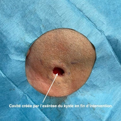 kyste epidermique angle mandibulaire droit dr arnaud petit chirurgien esthetique paris 8