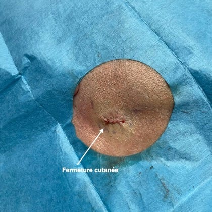 kyste epidermique angle mandibulaire droit dr arnaud petit chirurgien esthetique paris 9